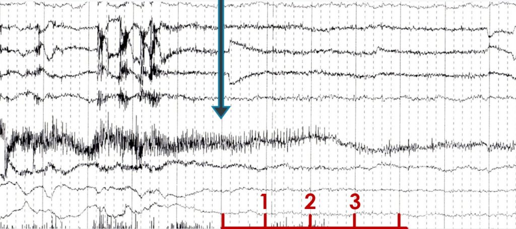 Relevé d’électroencéphalogramme d’un patient souffrant d’une paralysie douloureuse du nerf facial, pendant la stimulation sur le point de correspondance, montrant un temps de réaction de 3 secondes sur le tracé.